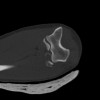 SPORK, NICO - 22.03.1976 - 02.08.2022 - CT obere Extremität - 18:02:23